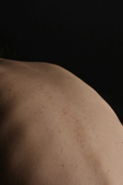 Gerincferdülés és idegbecsípődés