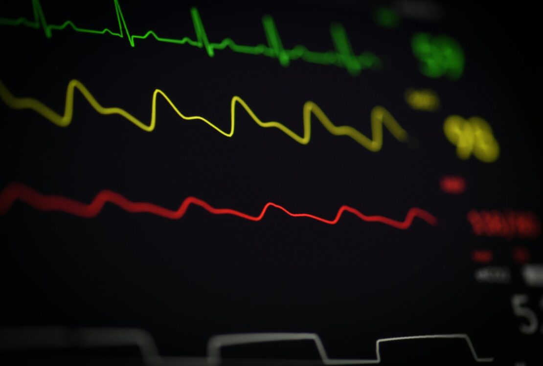 Terheléses EKG vizsgálat